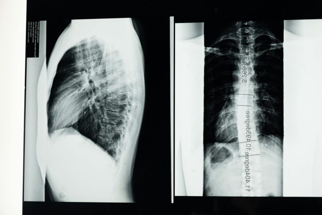 Bone Cancer